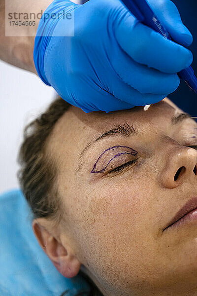 Chirurg zeichnet mit Marker eine Linie auf das Auge des Mädchens und bereitet sich auf den Eingriff vor.
