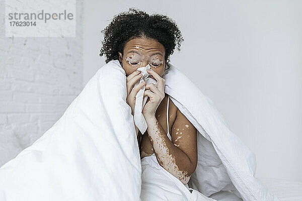 Kranke Frau mit Vitiligo putzt sich zu Hause in Seidenpapier die Nase