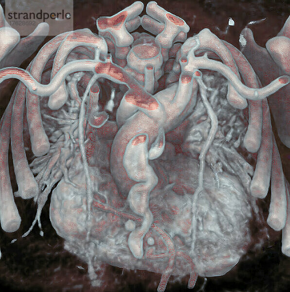 Thorax eines Neugeborenen: Mediastinum  Herz  Aorta und Brustarterien sind sichtbar. 3D-CT-Scan.