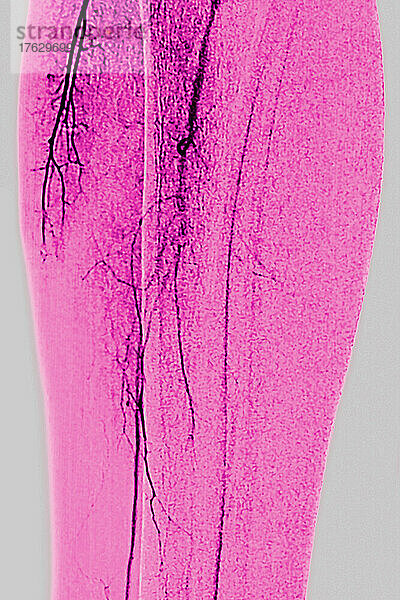 Arteriitis in einer unteren Extremität (fortschreitender Verschluss der Arterien  die die Gliedmaßen und Organe versorgen). Angiographie einer unteren Extremität.