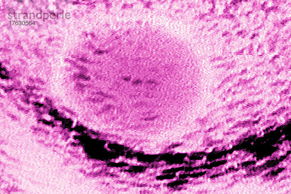 Hodenkrebs vom Seminomtyp  sichtbar durch Ultraschall.