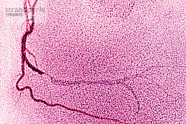 Angiographie eines Myokardinfarkts  der durch atheromatöse Plaque in der rechten Koronararterie verursacht wird. Die angiographische Visualisierung erfolgt durch Injektion eines Kontrastmittels.