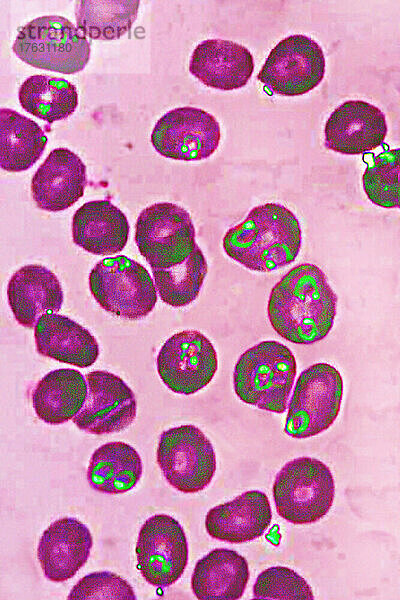 Plasmodium falciparum ist ein Malaria-verursachender Parasit oder Malaria  der durch den Biss weiblicher Anopheles übertragen wird und Merozoiten ins Blut freisetzt  die in die roten Blutkörperchen eindringen. optische Mikroskopansicht.