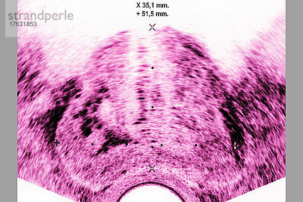 Prostatakrebs (Adenokarzinom der Prostata)  sichtbar durch Ultraschall.