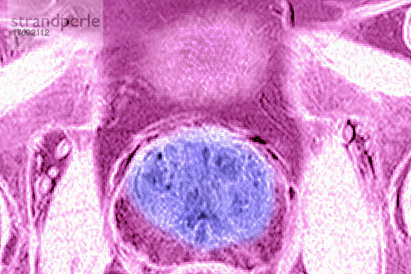 Gutartige Prostatahypertrophie  sichtbar durch radiales MRT des Beckens.