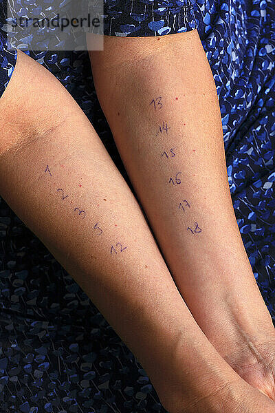 Hände einer Frau mit Allergietestnummern
