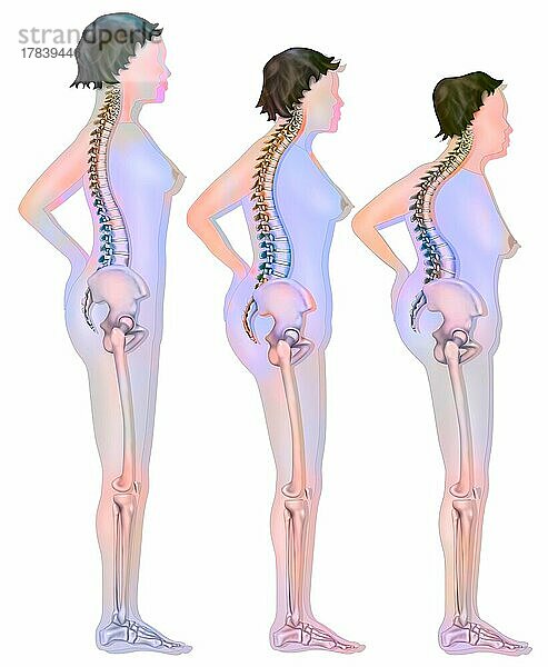 Veränderung der Silhouette im Zusammenhang mit Osteoporose (Wirbelkompression).