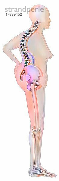 Knochensystem: Silhouette einer 70-jährigen Frau mit schwerer Osteoporose.