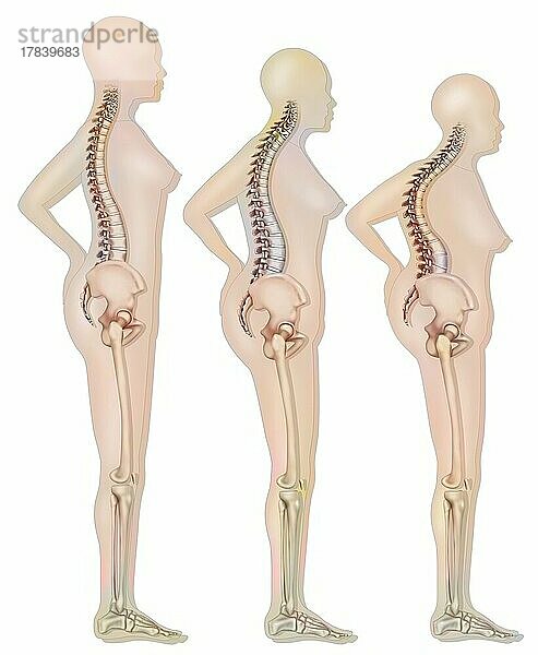 Veränderung der Silhouette im Zusammenhang mit Osteoporose (Wirbelkompression).