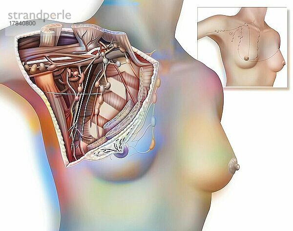 Versengte Achselhöhle und Lymphknotenkette. Schnittansicht der Achselhöhle  um die Ganglionkette der Achselhöhle und ihre Beziehung zu anderen Elementen dieser Region  Blutgefäßen und Muskelebenen  zu zeigen. Zoom der axillären und thorakalen Lymphknotenkette in der Brust einer Frau.