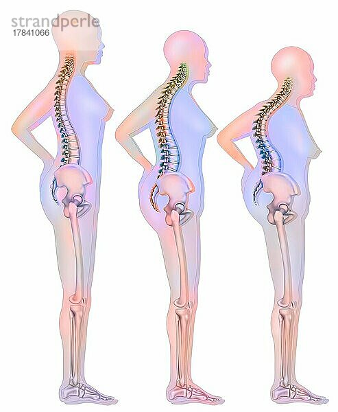 Veränderung der Silhouette im Zusammenhang mit Osteoporose (Wirbelkompression).