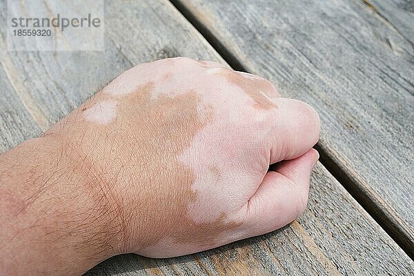 Männliche Hand mit Vitiligo  gekennzeichnet durch weiße  unpigmentierte Flecken oder Flecken