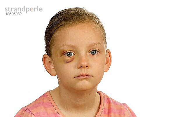Mädchen mit Verletzung  blaues Auge  Hämatom  Bluterguss  Kindesmisshandlung