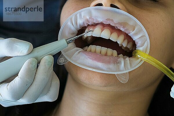 Nahaufnahme der hygienischen Reinigung der Zähne von Plaque. Die Hände des Zahnarztes reinigen die Zähne des Patienten von Plaque mit einem speziellen Gerät. Konzept der Zahnaufhellung  Zahnpflege  Mundgesundheit  Zahnmedizin Werbung