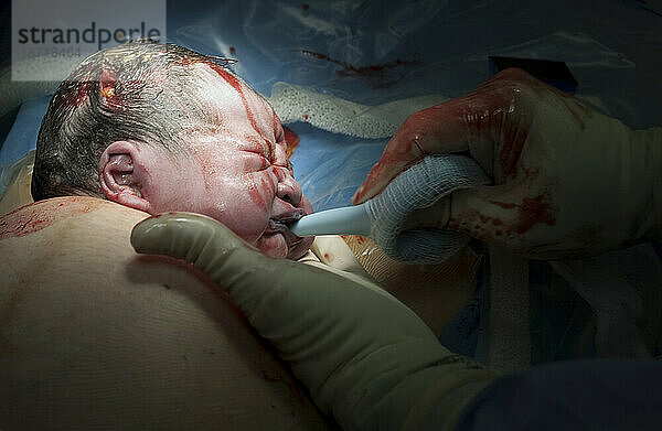Asiatisches Baby per Kaiserschnitt geboren