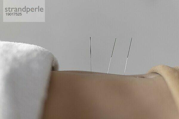 Close up Akupunktur Verfahren. Auflösung und hohe Qualität schönes Foto