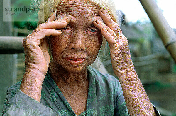 Ältere Albino-Frau in einem abgelegenen Dorf  Sumbawa Village  Sumbawa  Indonesien