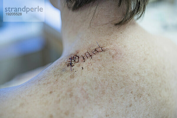Medizinische Nähte im Rücken einer Frau nach der Operation