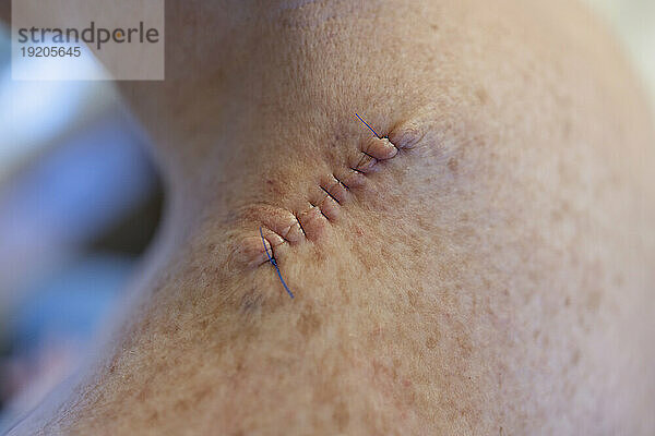 Medical stitches in woman's back after surgery