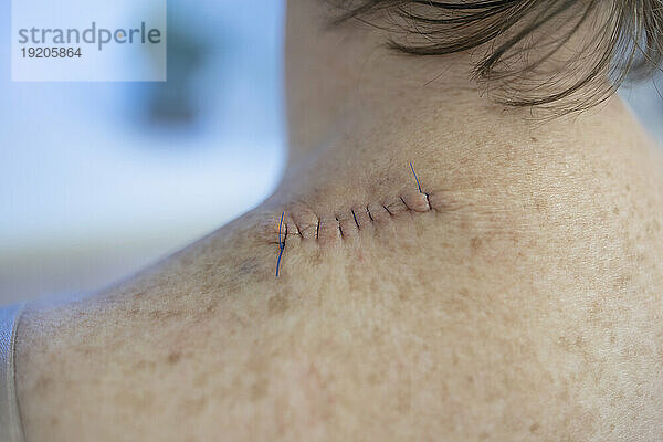 Medizinische Nähte im Rücken einer Frau nach der Operation