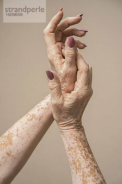 Hands of senior woman with vitiligo against pink background