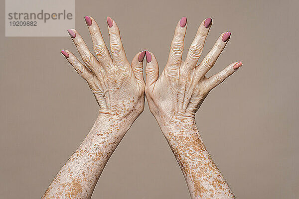Woman showing hands with vitiligo against pink background