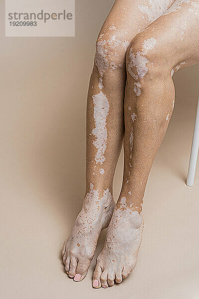 Legs of woman with vitiligo