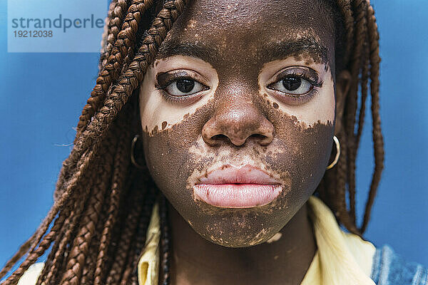 Junge Frau mit Depigmentierung im Gesicht vor blauem Hintergrund