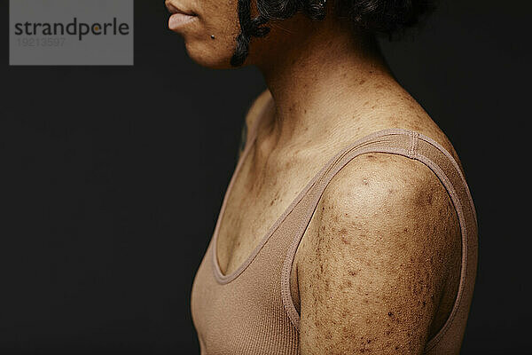 Woman with acne scars on skin against black background