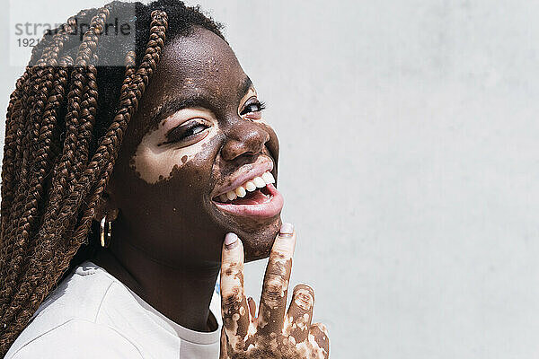 Glückliche junge Frau mit Vitiligo und Depigmentierung vor weißer Wand