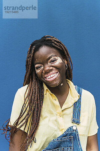 Smiling young woman with vitiligo in front of blue wall