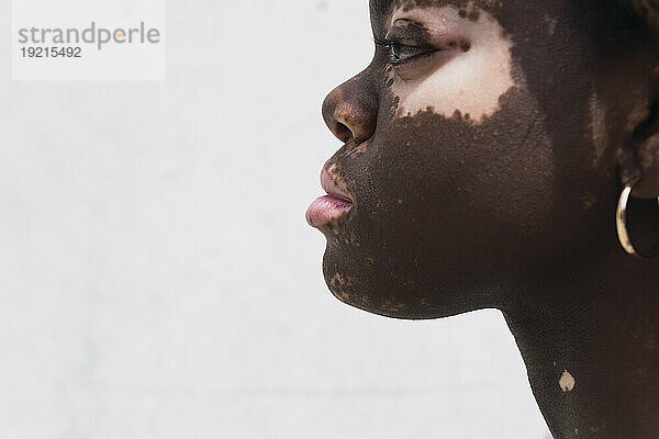 Junge Frau mit Vitiligo und Depigmentierung vor weißer Wand