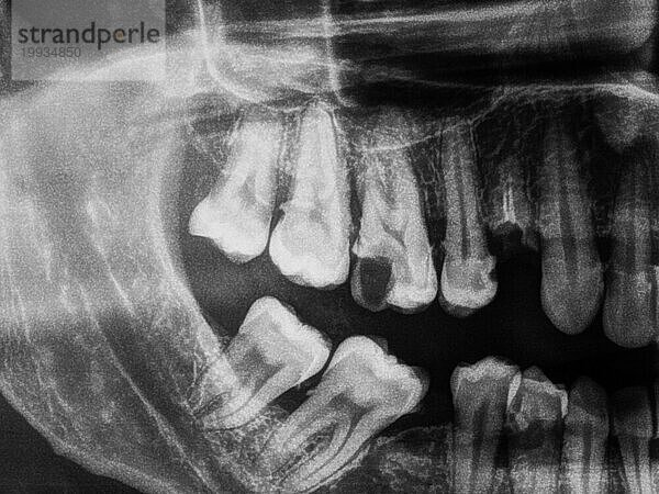 Röntgenbild der menschlichen Zähne in schwarzweiß