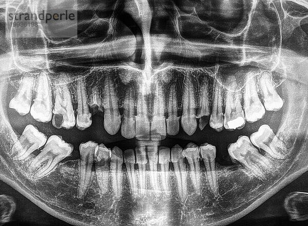 Röntgenbild der menschlichen Zähne in schwarzweiß