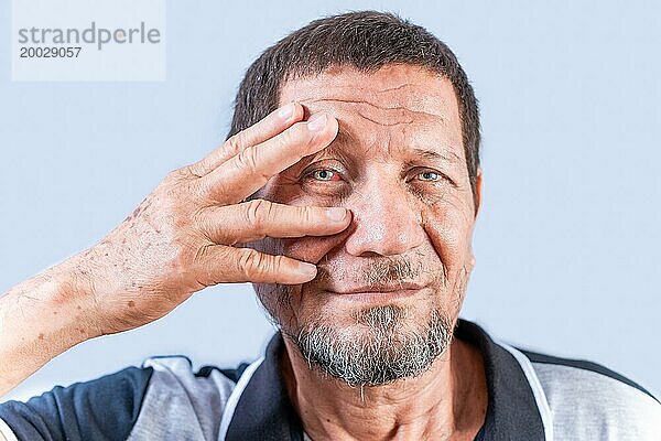 Älterer Mensch mit gereizten Augen. Älterer Mann mit Augenschmerzen isoliert. Alter Mann mit Bindehautentzündung auf weißem Hintergrund