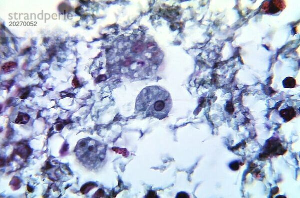 Bei 900-facher Vergrößerung zeigte diese Mikrofotografie das Vorhandensein des parasitären Organismus Entamoeba histolytica in dieser Amöbom-Gewebeprobe. Ein Amöben  auch Amöbengranulom genannt  ist eine mögliche Komplikation einer Amöbeninfektion  bei der sich um den Erreger herum ein Granulom bildet  meist in der Wand des Blinddarms und des aufsteigenden Dickdarms. CDC/Dr. Healy 1966