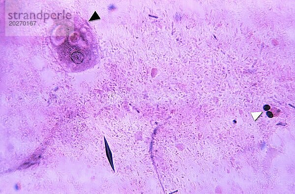 Unter 675-facher Vergrößerung zeigte diese Mikrofotografie das Vorhandensein eines Entamoeba histolytica-Trophozoiten (schwarze Pfeilspitze)  der aufgenommene rote Blutkörperchen (GRs)  eines rautenförmigen CharcotLeyden-Kristalls und zweier weißer Blutkörperchen (WBCs) enthält  die als Eosinophile bekannt sind (weiß). Pfeilspitze). CDC 1971