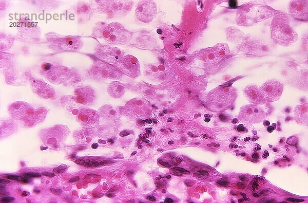 Unter einer 500-fachen Vergrößerung zeigte diese Mikrofotografie einer Darmschleimhautprobe die histopathologischen Veränderungen  die mit einer Amöbiasis-Infektion aufgrund des parasitären Organismus Entamoeba histolytica einhergehen. In dieser Ansicht können Sie zahlreiche E. histolytica-Trophozoiten sehen  von denen viele von roten Blutkörperchen (RBCs) aufgenommen wurden  die diese Amöben durch einen Prozess verschlungen haben  der als Erythrophagozytose bekannt ist. CDC 1970