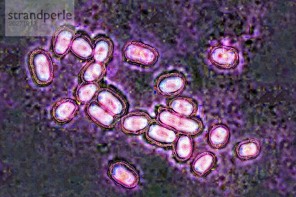 Pneumokokken (Streptococcus pneumoniae)  Pneumokokken  sind Bakterien  die an Lungenentzündung  Bronchopneumonie  eitriger Rippenfellentzündung  bakterieller Meningitis  Otitis  Sinusitis und Konjunktivitis beteiligt sind. Bild aus optischer Mikroskopie.