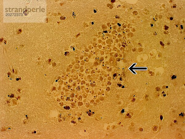 Ein mit Hämatoxylin und Eosin gefärbter Abschnitt des Gehirns eines Patienten mit primärer amöbenischer Meningoenzephalitis  der eine große Ansammlung von Naegleria fowleri-Trophozoiten um die Kapillaren zeigt. Vergrößerung: 400x.