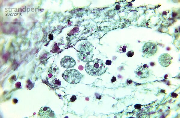 Bei 675-facher Vergrößerung zeigte diese Mikrofotografie das Vorhandensein parasitärer Organismen vom Typ Entamoeba histolytica in dieser Amömö-Gewebeprobe. Eine Amöbe  auch Amöbengranulom genannt  ist eine mögliche Komplikation einer Amöbeninfektion  bei der sich um den Erreger herum ein Granulom bildet  meist in der Wand des Blinddarms oder des aufsteigenden Dickdarms. CDC/Dr. Healy 1966