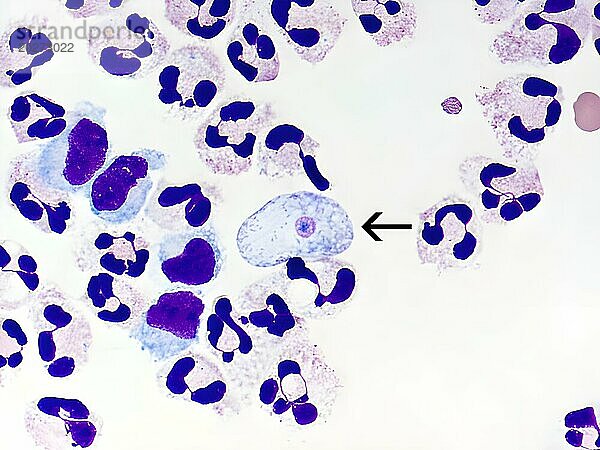 Ein fixierter Zytospin der Liquor cerebrospinalis  der einen Giemsa-Wright-gefärbten Naegleria fowleri-Trophozoiten (Pfeil) inmitten polymorphkerniger Leukozyten und einiger Lymphozyten zeigt. Im Trophozoiten sind der Kern und der Nukleolus zu erkennen. Vergrößerung: 1000x