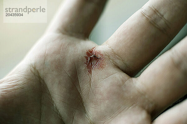 Detail of hand after crushing a blood filled mosquito in Malawi.