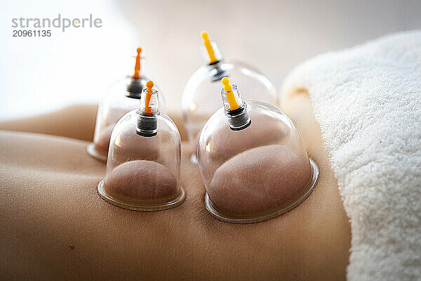 Teenager girl taking cupping therapy in clinic