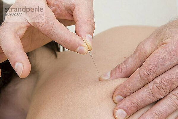 Set acupuncture needles in the facial area of a woman