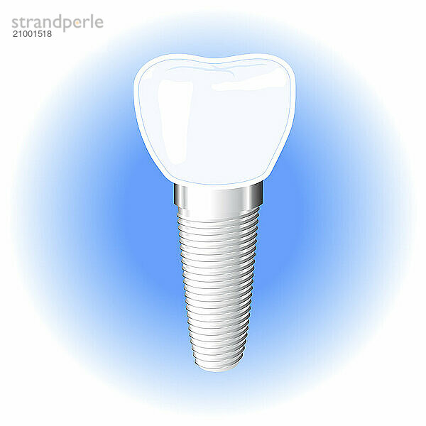 Dental implant vector illustration isolated on white blue background