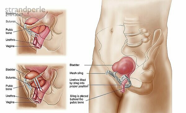 Anatomy of bladder suspension procedure for urinary incontinence in females