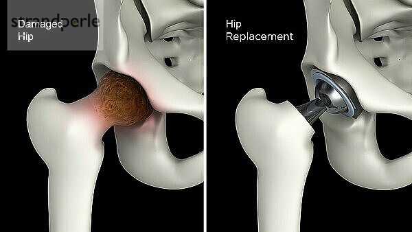 Medical illustration showing hip replacement of a damaged hip