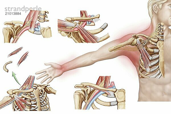 Medical illustration detailing thoracic outlet syndrome