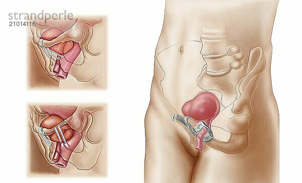 Anatomy of bladder suspension procedure for urinary incontinence in females